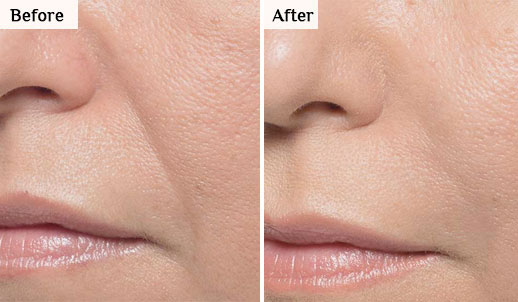 morpheus8 before after undereye